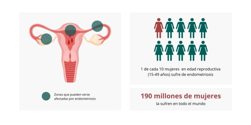 Endometriosis Y Esterilidad Reproducción Asistida Institut Marquès 7479